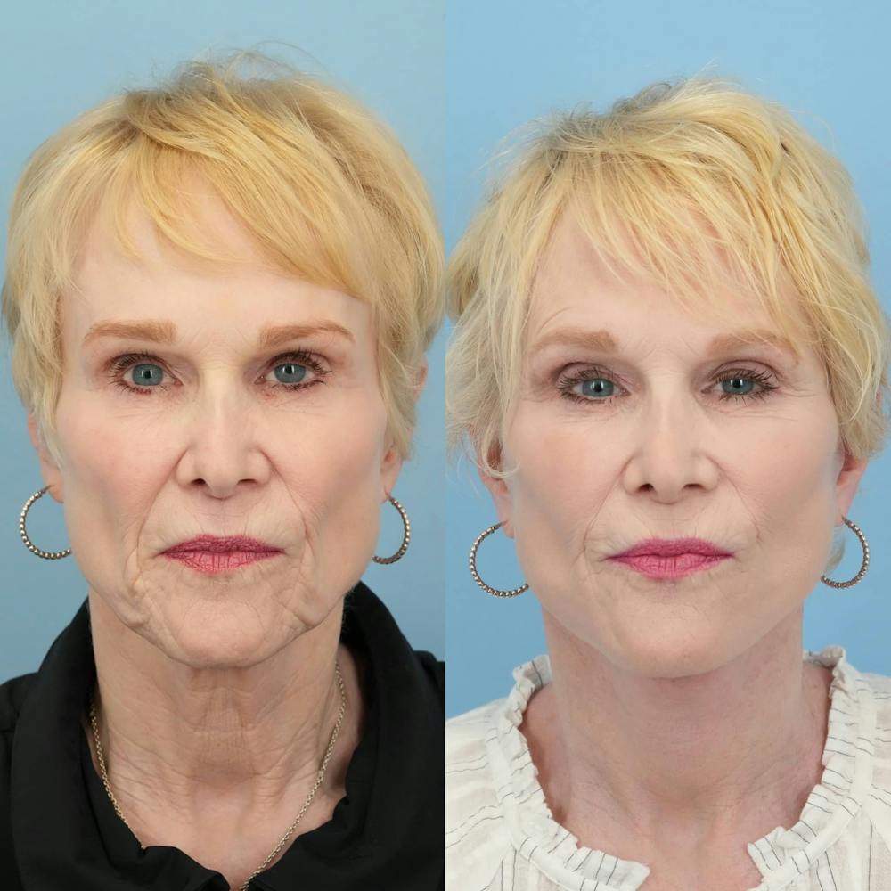 Facelift Before & After Gallery - Patient 279511 - Image 2