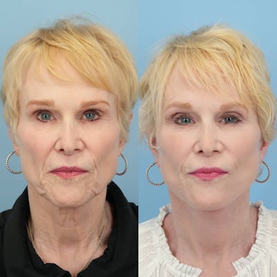Facelift Before & After Gallery - Patient 279511 - Image 2