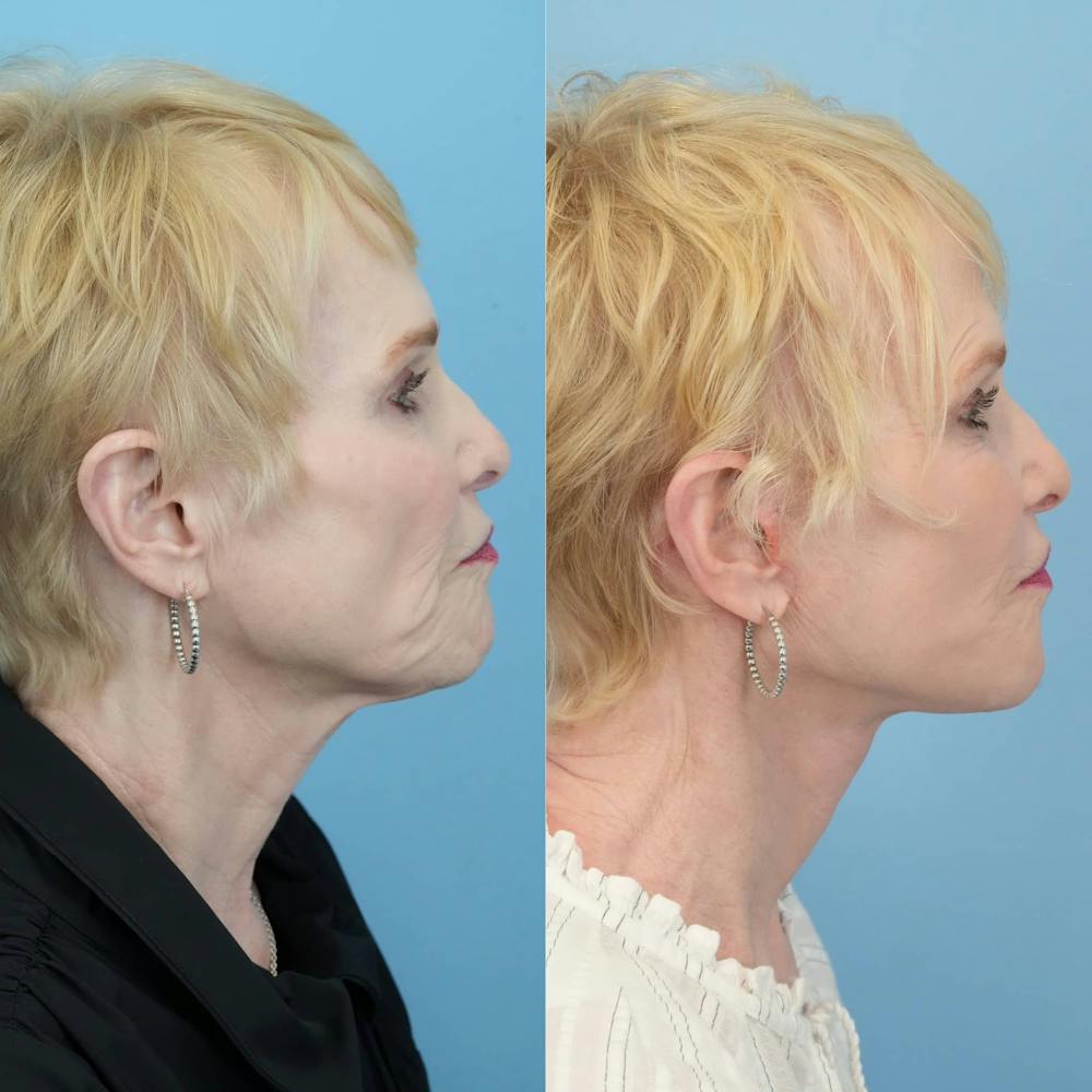 Facelift Before & After Gallery - Patient 279511 - Image 4
