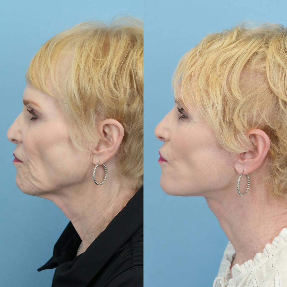 Facelift Before & After Gallery - Patient 279511 - Image 5