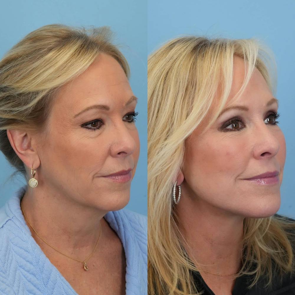 Facelift Before & After Gallery - Patient 322261 - Image 6