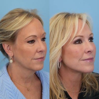 Facelift Before & After Gallery - Patient 322261 - Image 6