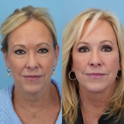 Facelift Before & After Gallery - Patient 322261 - Image 2