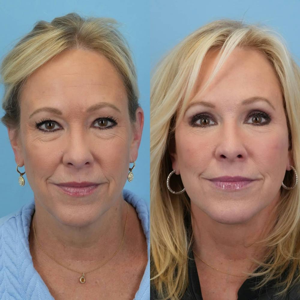 Facelift Before & After Gallery - Patient 322261 - Image 2