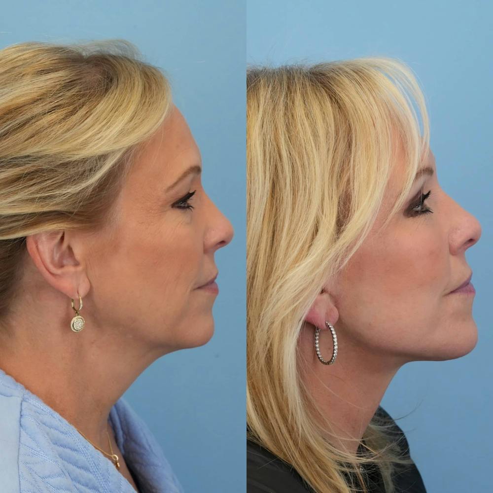 Facelift Before & After Gallery - Patient 322261 - Image 5