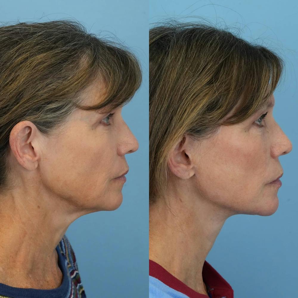 Facelift Before & After Gallery - Patient 150637 - Image 3