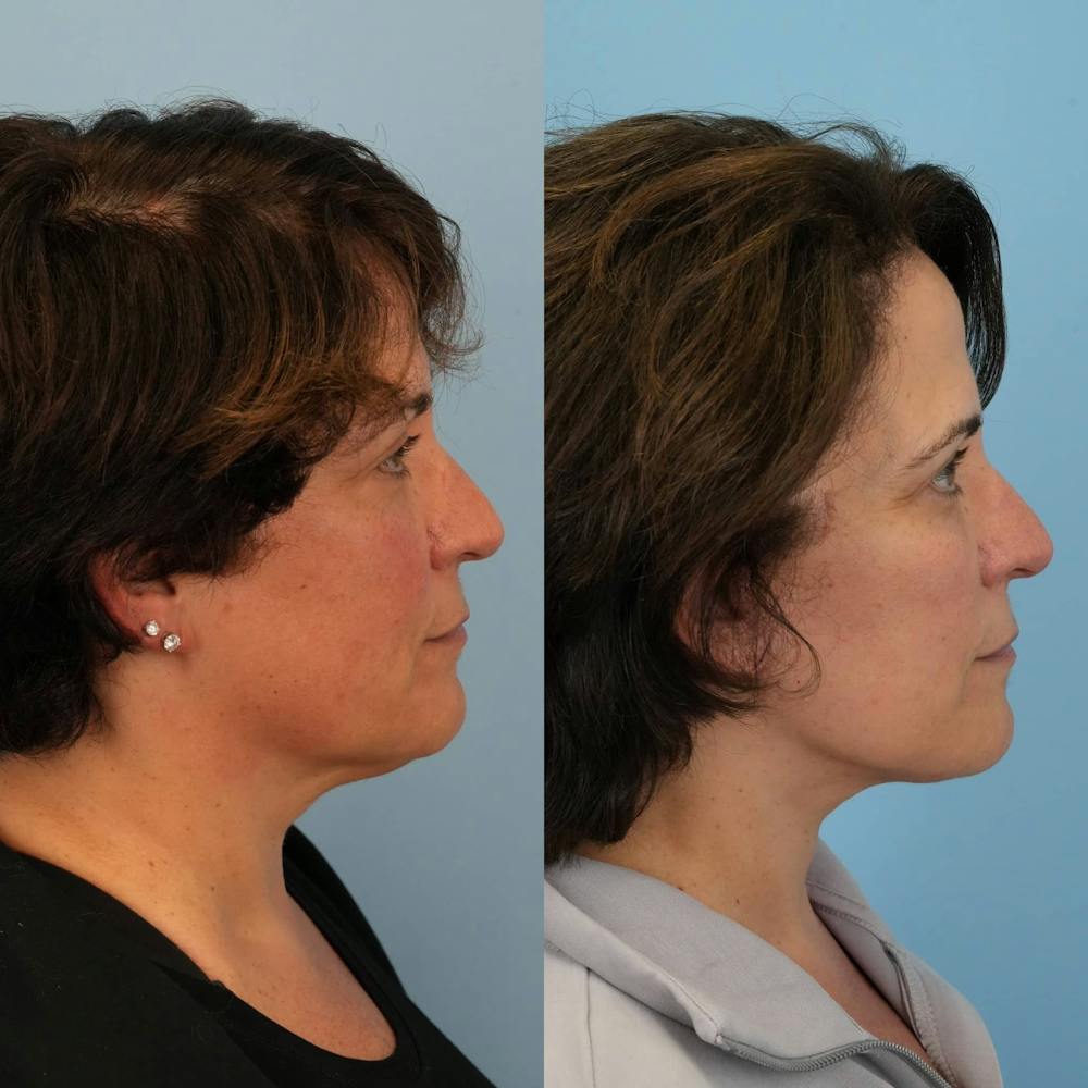 Facelift Before & After Gallery - Patient 257534 - Image 3