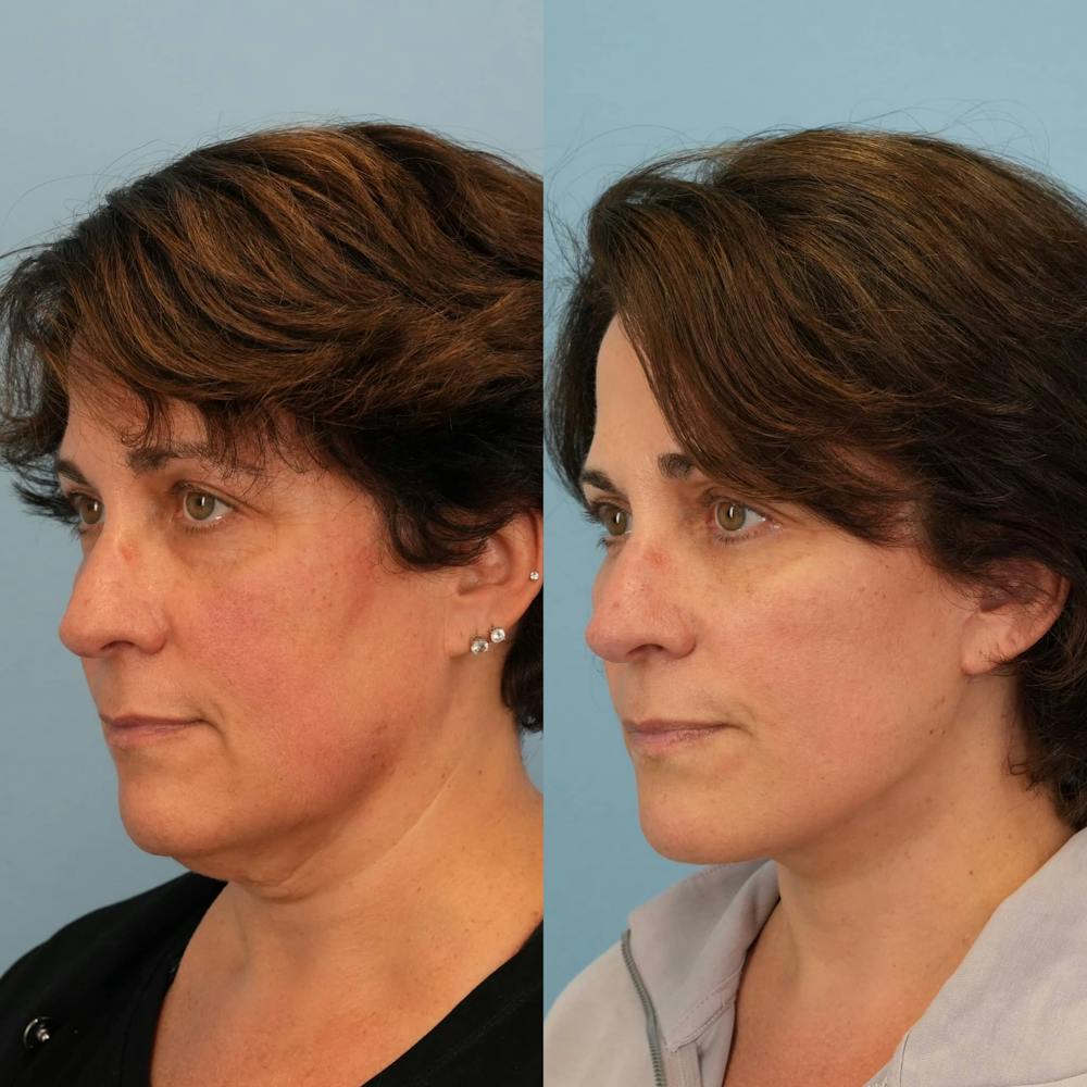 Facelift Before & After Gallery - Patient 257534 - Image 5