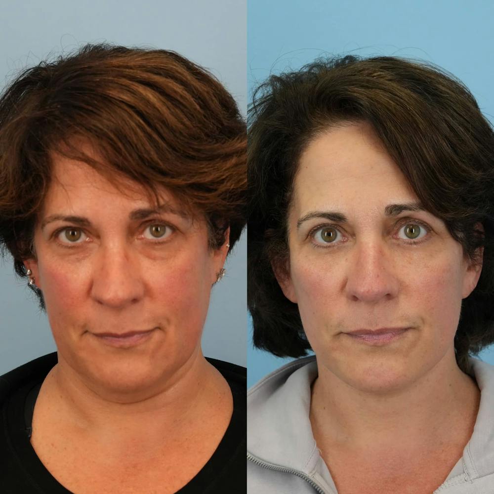 Facelift Before & After Gallery - Patient 257534 - Image 1