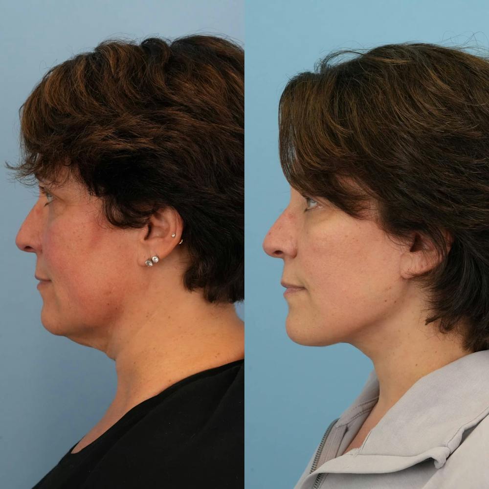 Facelift Before & After Gallery - Patient 257534 - Image 4