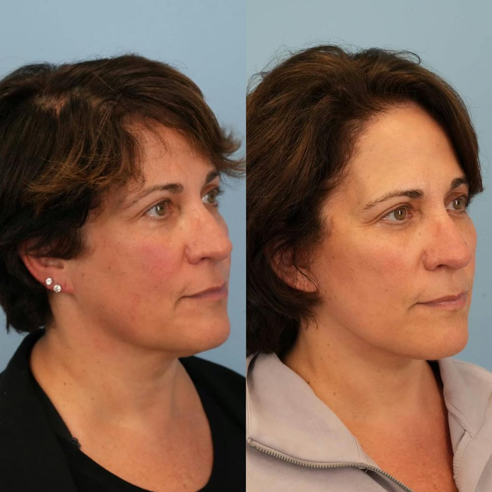 Facelift Before & After Gallery - Patient 257534 - Image 2