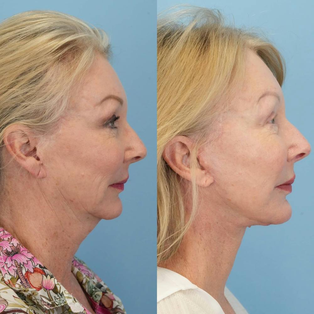 Facelift Before & After Gallery - Patient 915237 - Image 4