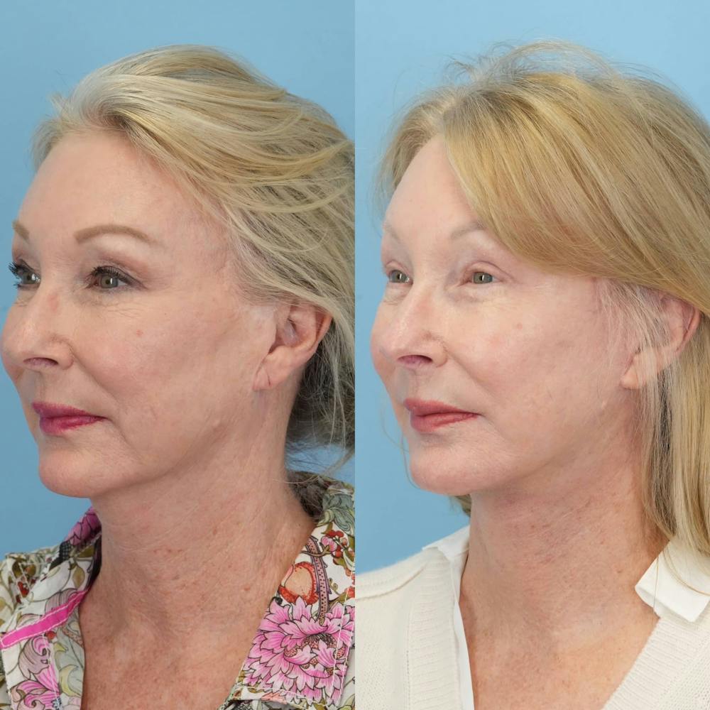 Facelift Before & After Gallery - Patient 915237 - Image 2