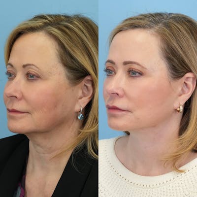 Facelift Before & After Gallery - Patient 334018 - Image 2