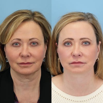 Facelift Before & After Gallery - Patient 334018 - Image 1