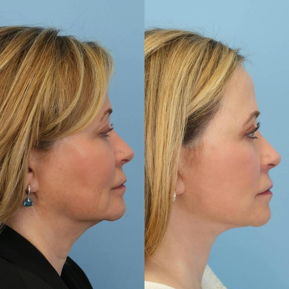 Facelift Before & After Gallery - Patient 334018 - Image 4