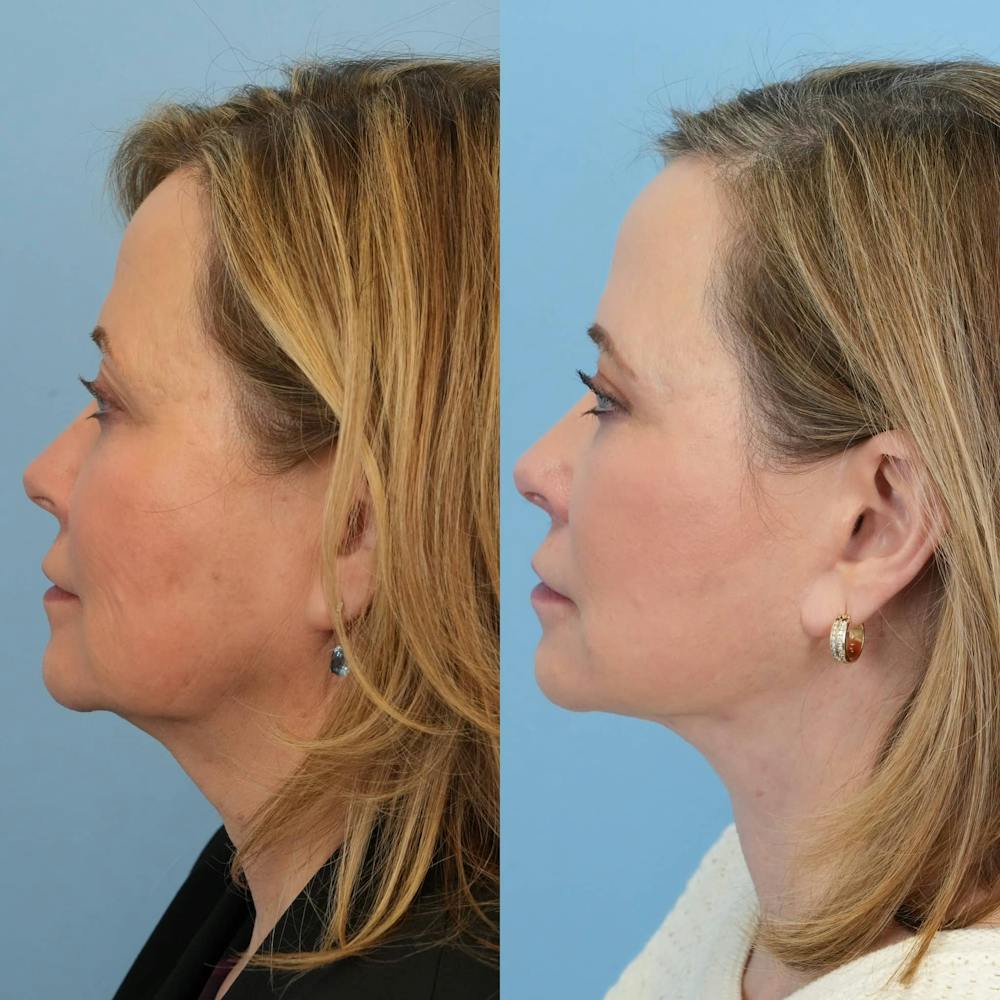 Facelift Before & After Gallery - Patient 334018 - Image 3