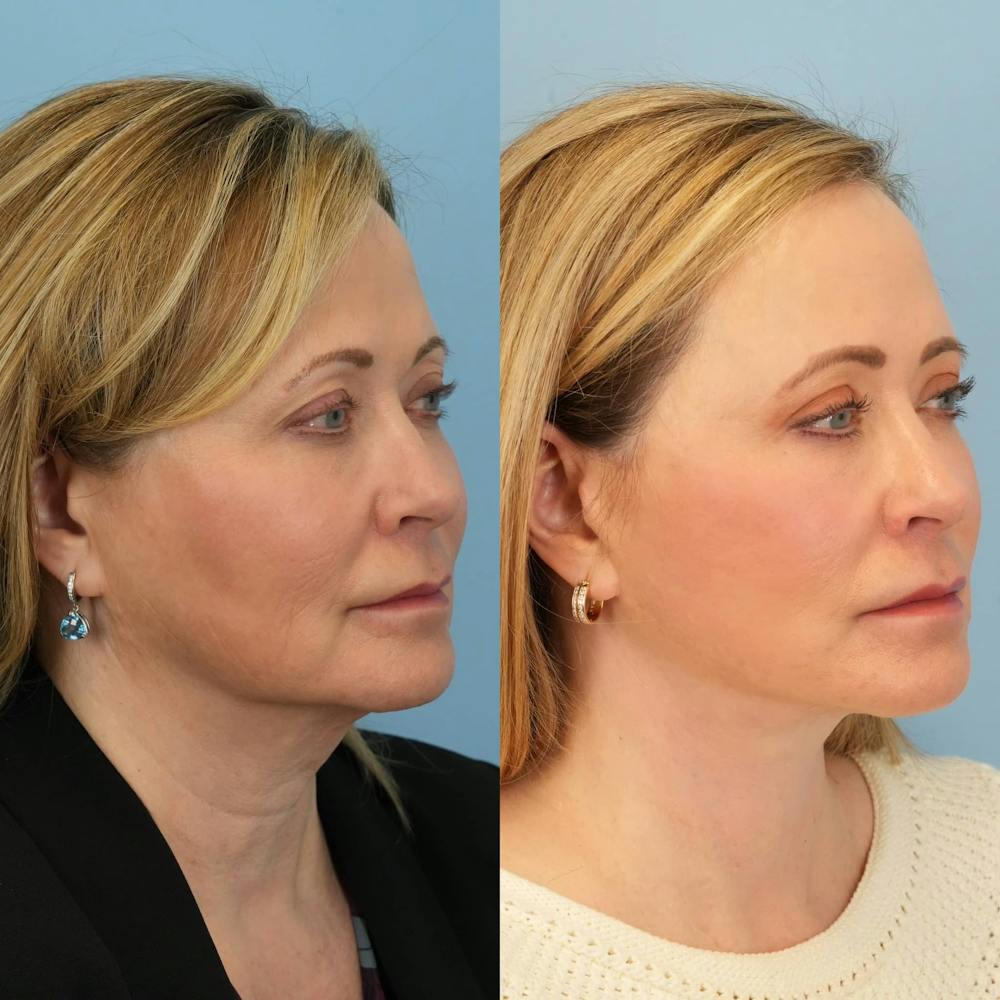 Facelift Before & After Gallery - Patient 334018 - Image 5