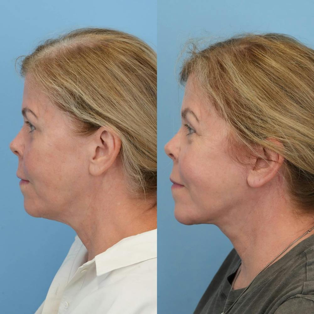 Facelift Before & After Gallery - Patient 203257 - Image 3