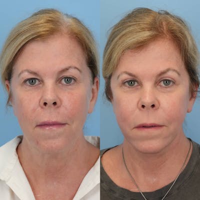 Facelift Before & After Gallery - Patient 203257 - Image 1