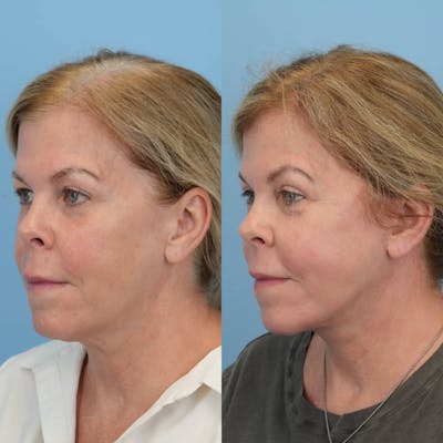 Facelift Before & After Gallery - Patient 203257 - Image 2
