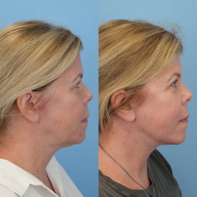 Facelift Before & After Gallery - Patient 203257 - Image 4