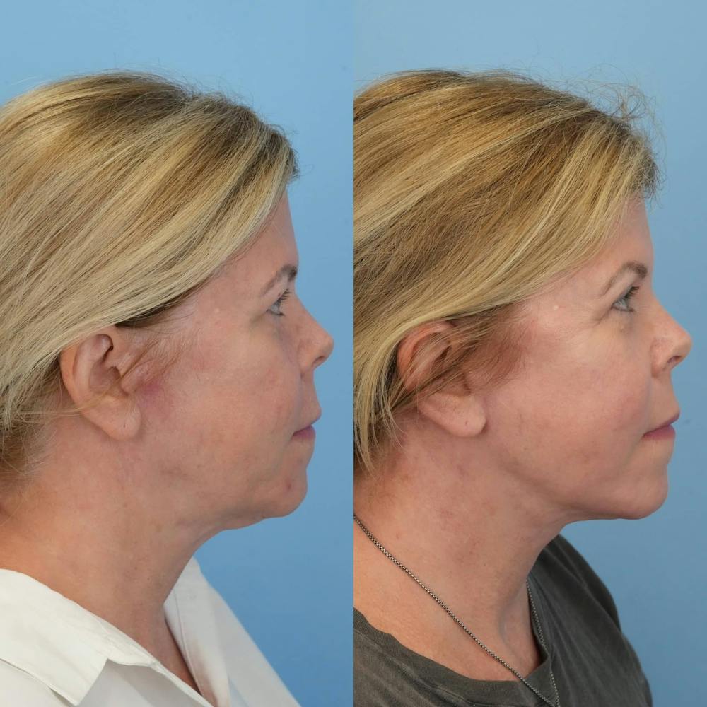 Facelift Before & After Gallery - Patient 203257 - Image 4