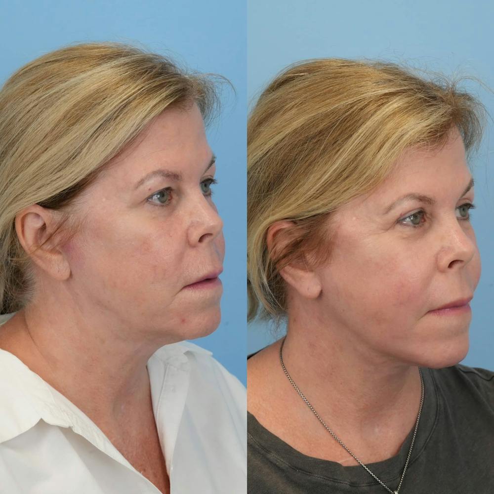 Facelift Before & After Gallery - Patient 203257 - Image 5