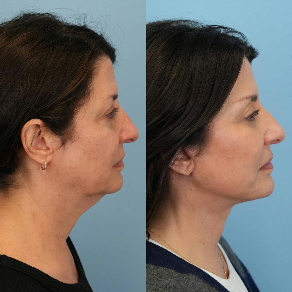 Facelift Before & After Gallery - Patient 328723 - Image 3