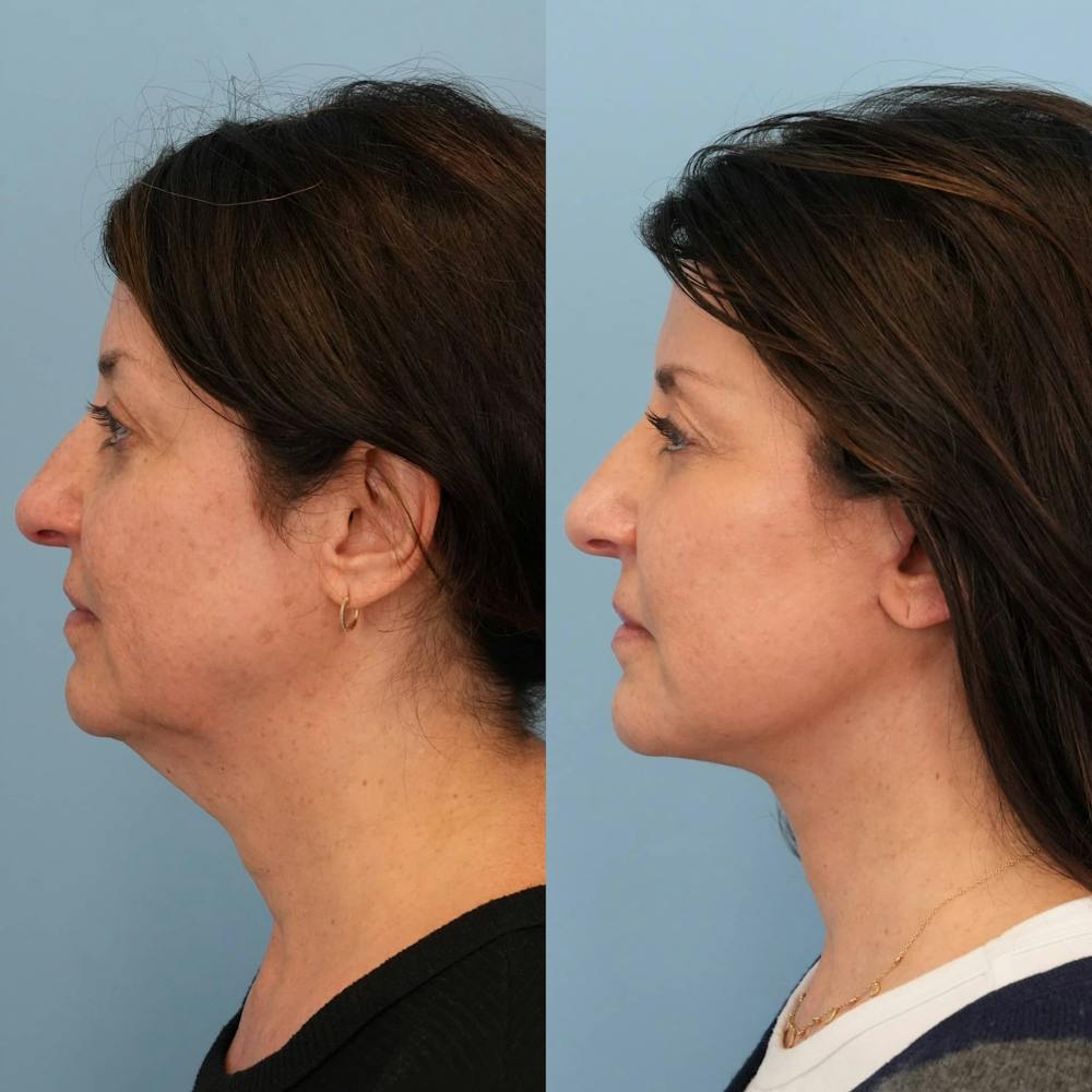 Facelift Before & After Gallery - Patient 328723 - Image 4