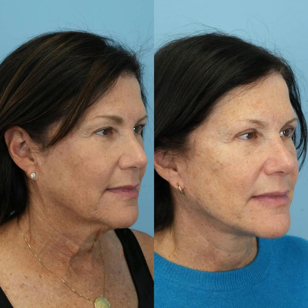 Facelift Before & After Gallery - Patient 899067 - Image 2