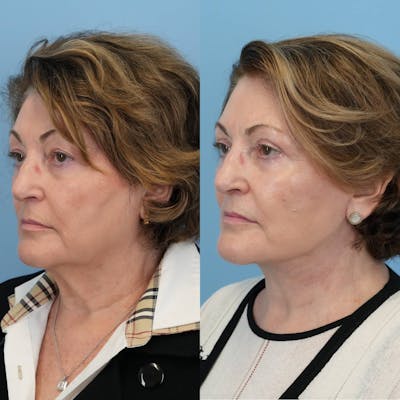 Facelift Before & After Gallery - Patient 322088 - Image 2