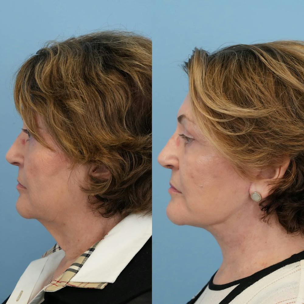 Facelift Before & After Gallery - Patient 322088 - Image 3