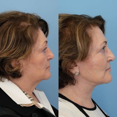Facelift Before & After Gallery - Patient 322088 - Image 4