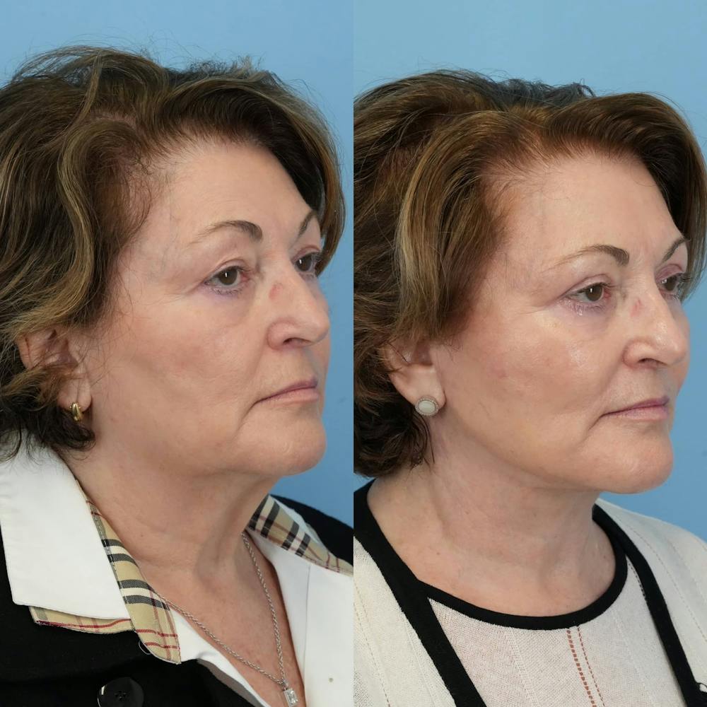 Facelift Before & After Gallery - Patient 322088 - Image 5