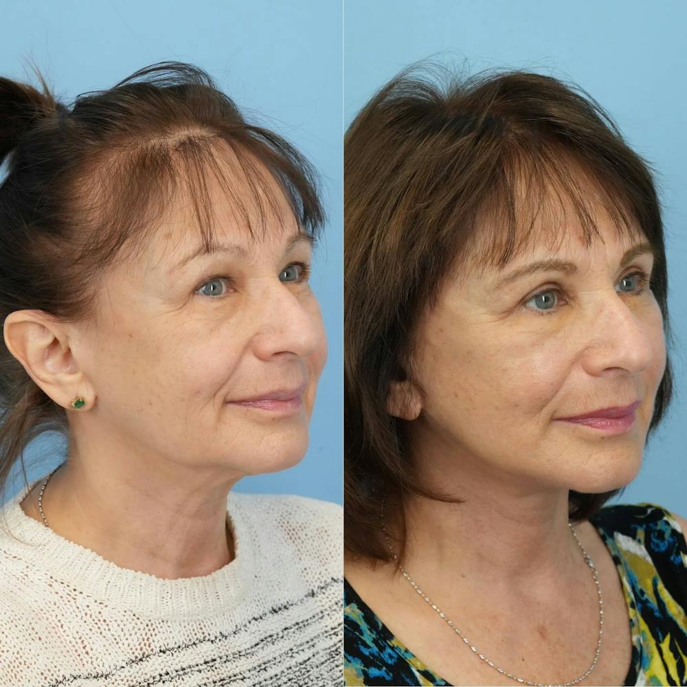 Facelift Before & After Gallery - Patient 198377 - Image 2