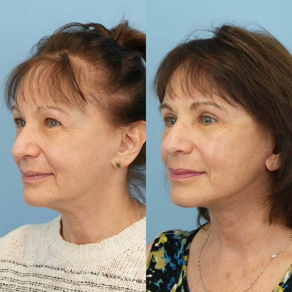 Facelift Before & After Gallery - Patient 198377 - Image 5