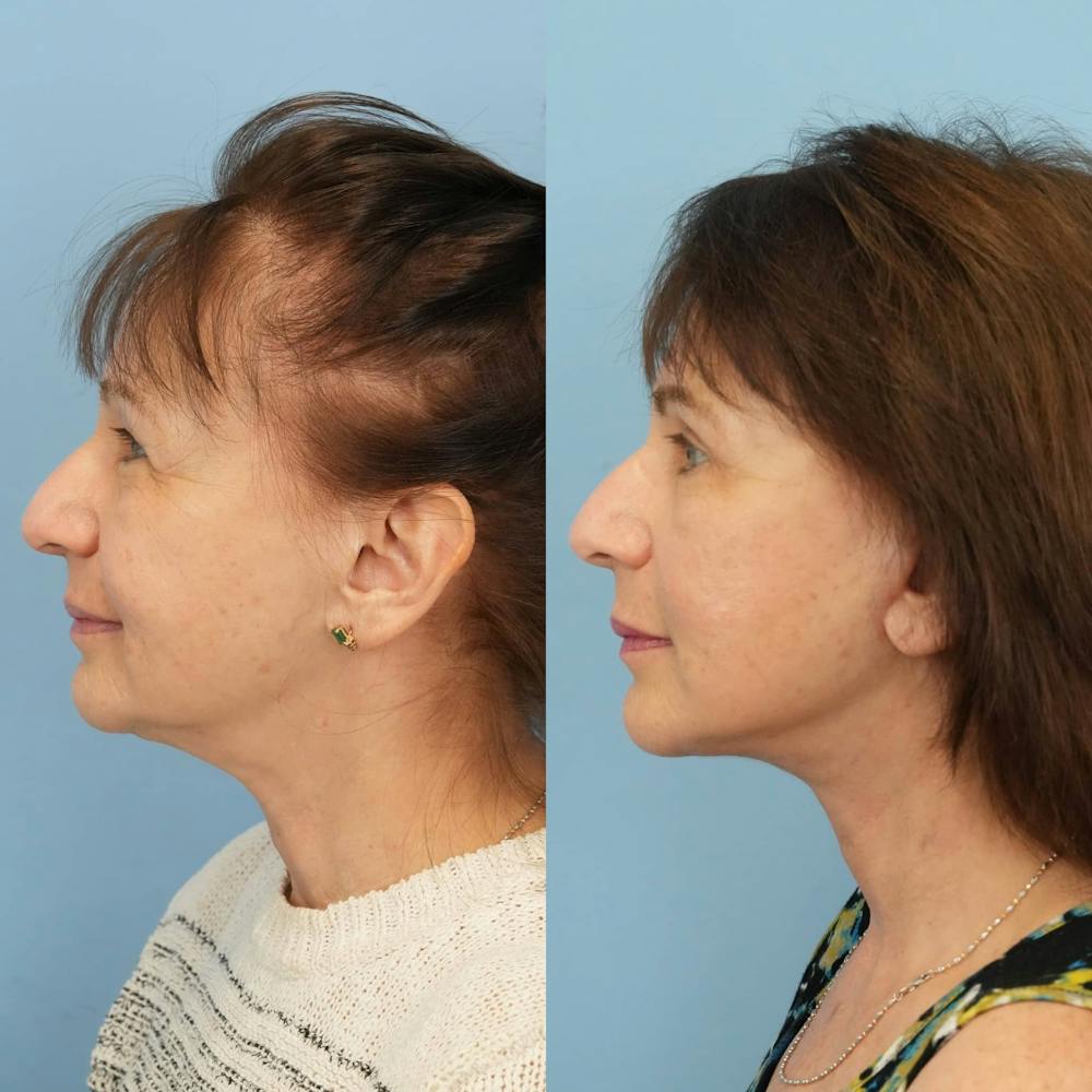 Facelift Before & After Gallery - Patient 198377 - Image 4