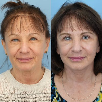 Facelift Before & After Gallery - Patient 198377 - Image 1