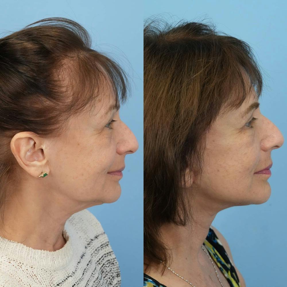 Facelift Before & After Gallery - Patient 198377 - Image 3