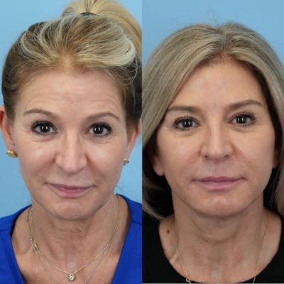 Facelift Before & After Gallery - Patient 172752 - Image 1