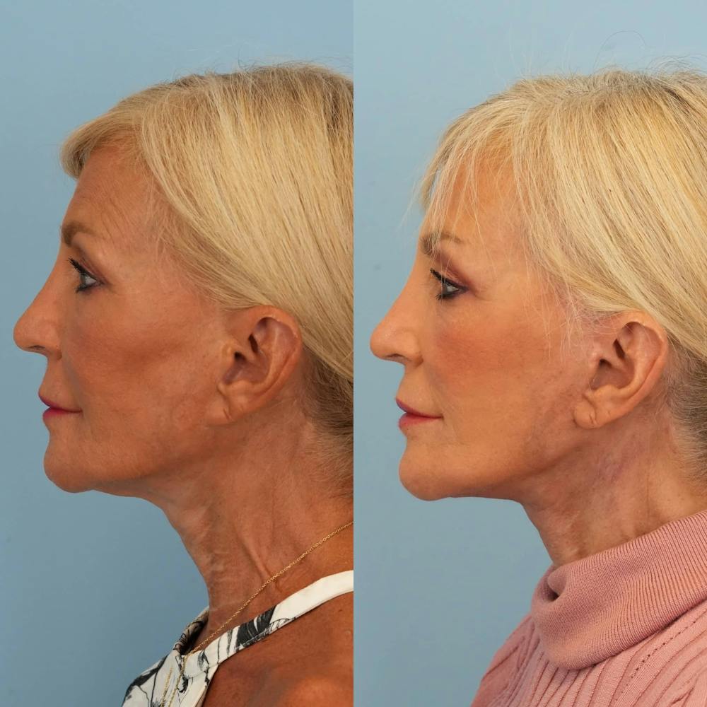 Facelift Before & After Gallery - Patient 301183 - Image 3