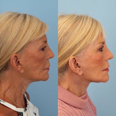 Facelift Before & After Gallery - Patient 301183 - Image 4