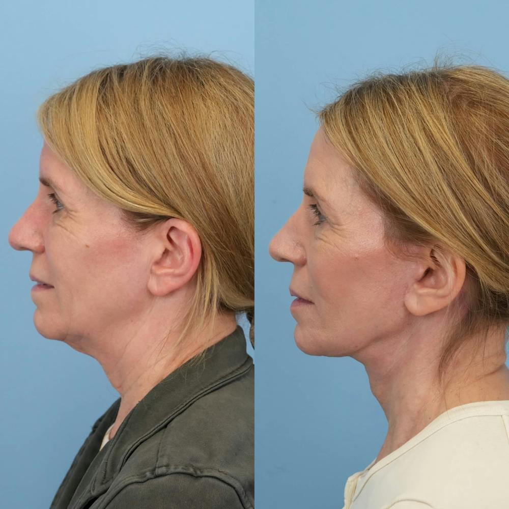 Facelift Before & After Gallery - Patient 313661 - Image 4