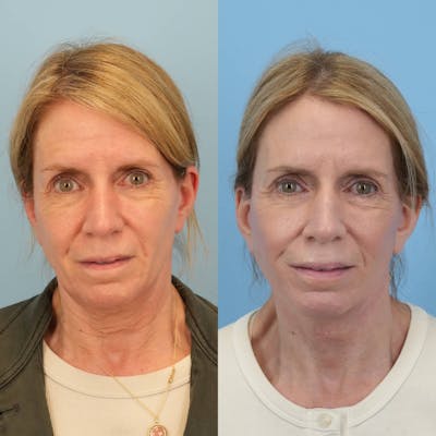 Facelift Before & After Gallery - Patient 313661 - Image 1