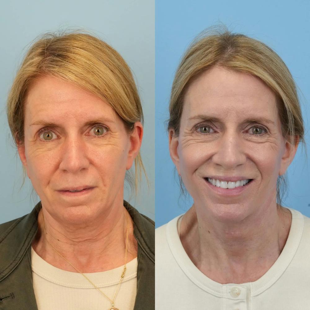 Facelift Before & After Gallery - Patient 313661 - Image 2