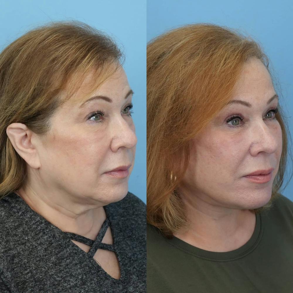 Facelift Before & After Gallery - Patient 143357 - Image 3