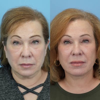 Facelift Before & After Gallery - Patient 143357 - Image 1