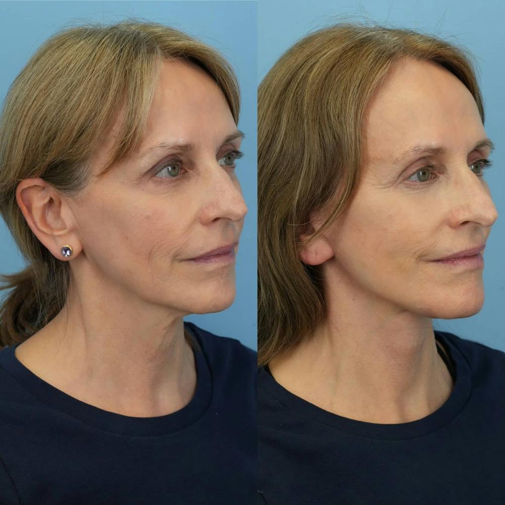 Facelift Before & After Gallery - Patient 310119 - Image 2