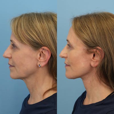 Facelift Before & After Gallery - Patient 310119 - Image 4